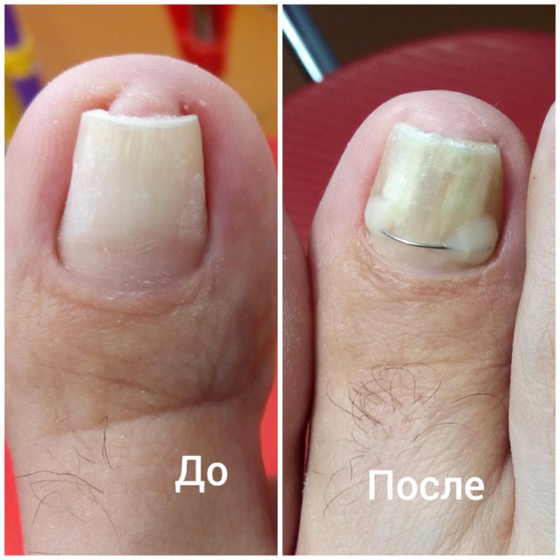 Подологический и эстетический педикюр. - Орск